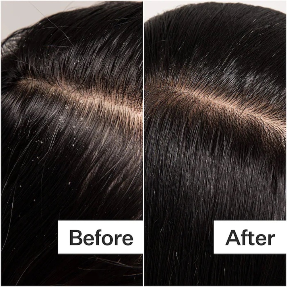 Act+Acre Cold Processed Scalp Detox Oil For Dry Scalp - Picture 2 of 15